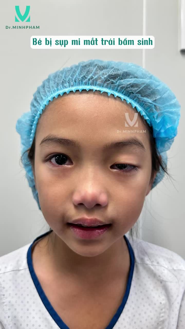 Từng bị sụp mí bẩm sinh khiến ánh nhìn không đều, nhưng giờ đây bé Thủy Tiên đã có đôi mắt sáng và tự nhiên nhờ phương pháp treo mi vạt cơ trán được thực hiện bởi Dr Minh Phạm