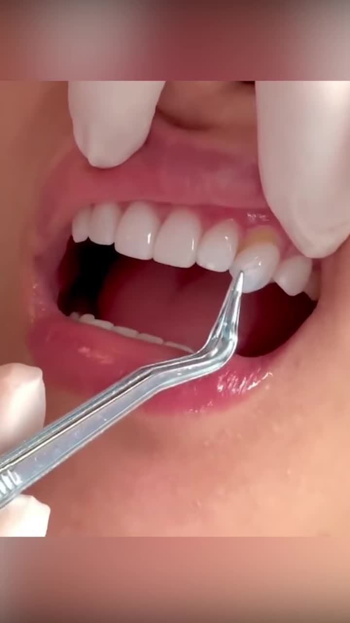 Dán sứ siêu mỏng