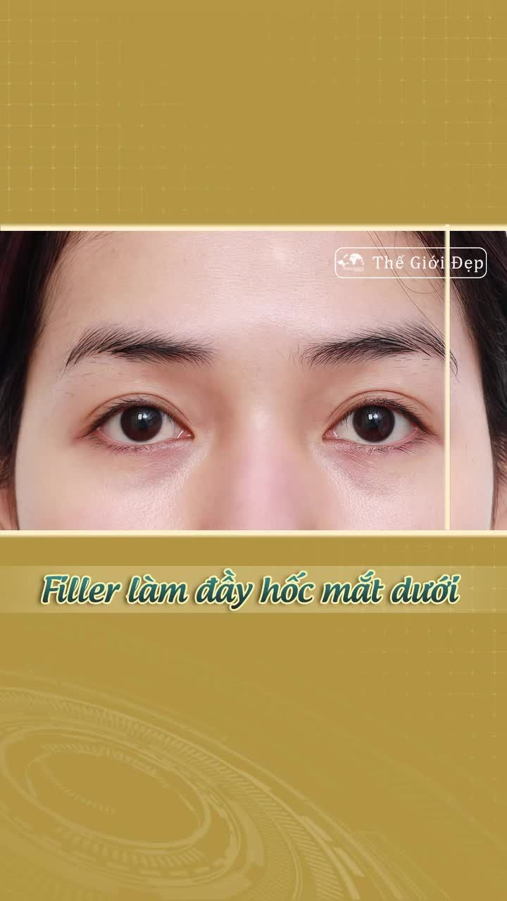 Cải thiện hốc mắt trũng sâu, trả lại ánh nhìn tươi tắn nhanh chóng bằng chất làm đầy mà không cần can thiệp phức tạp!