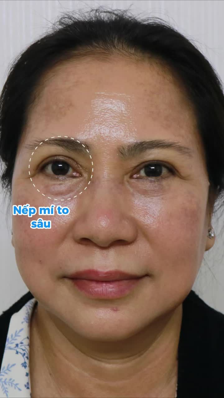 MẮT HỎNG, NẾP MÍ KHÔNG ĐỀU? SỬA MÍ TÁI TẠO ĐÔI MẮT THẦN THÁI!