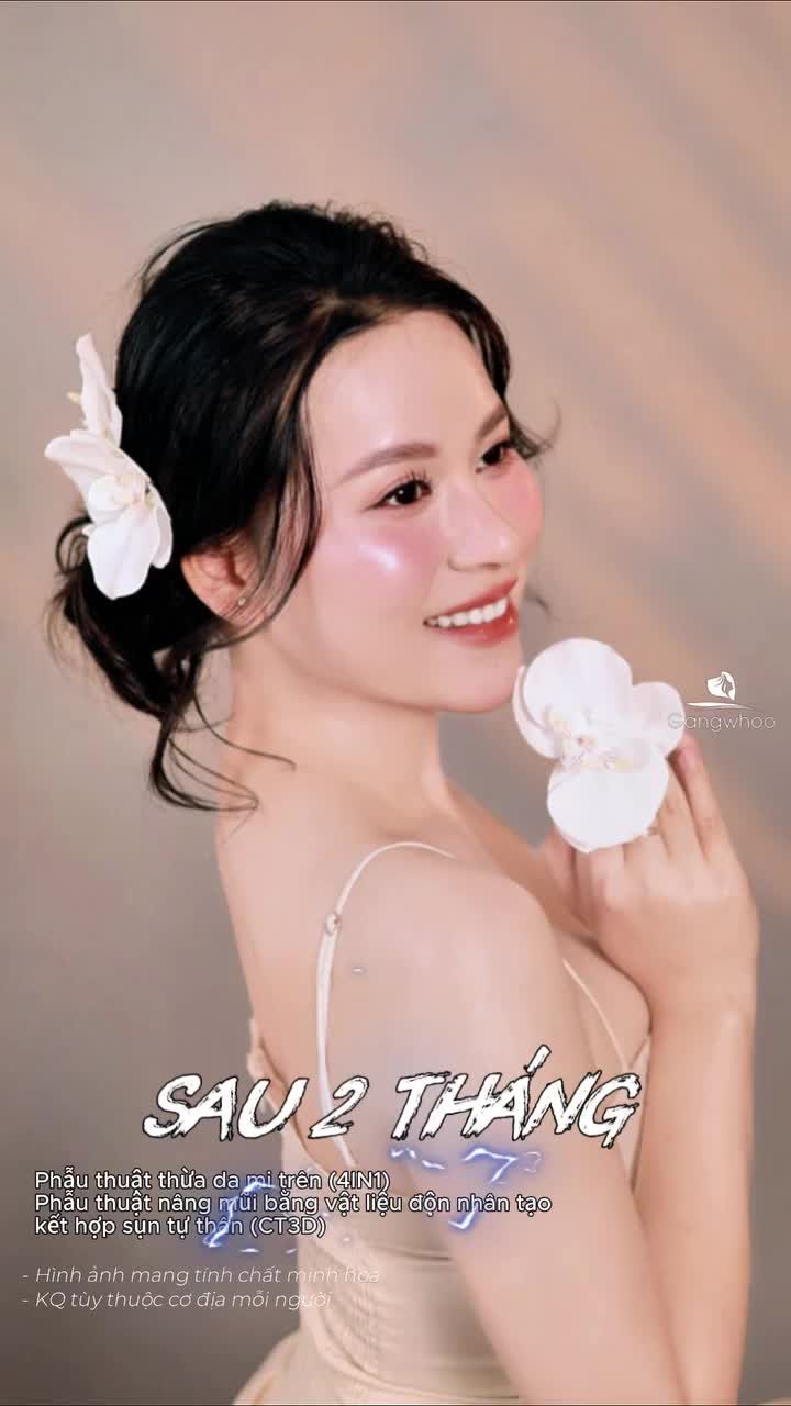 Chỉ sau 2 tháng, diện mạo thay đổi rõ rệt: đôi mắt có hồn và cân đối hơn, sống mũi cao thẳng tự nhiên.