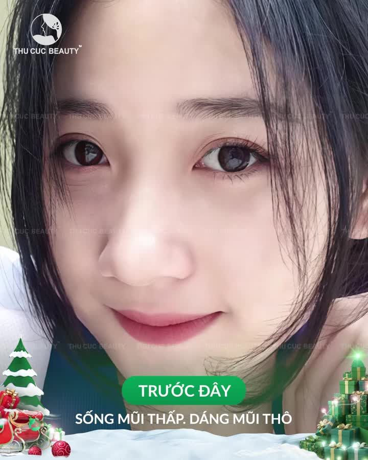 Khắc phục với Mũi TC - Tinh chỉnh sống cao thon, chuẩn tỷ lệ vàng