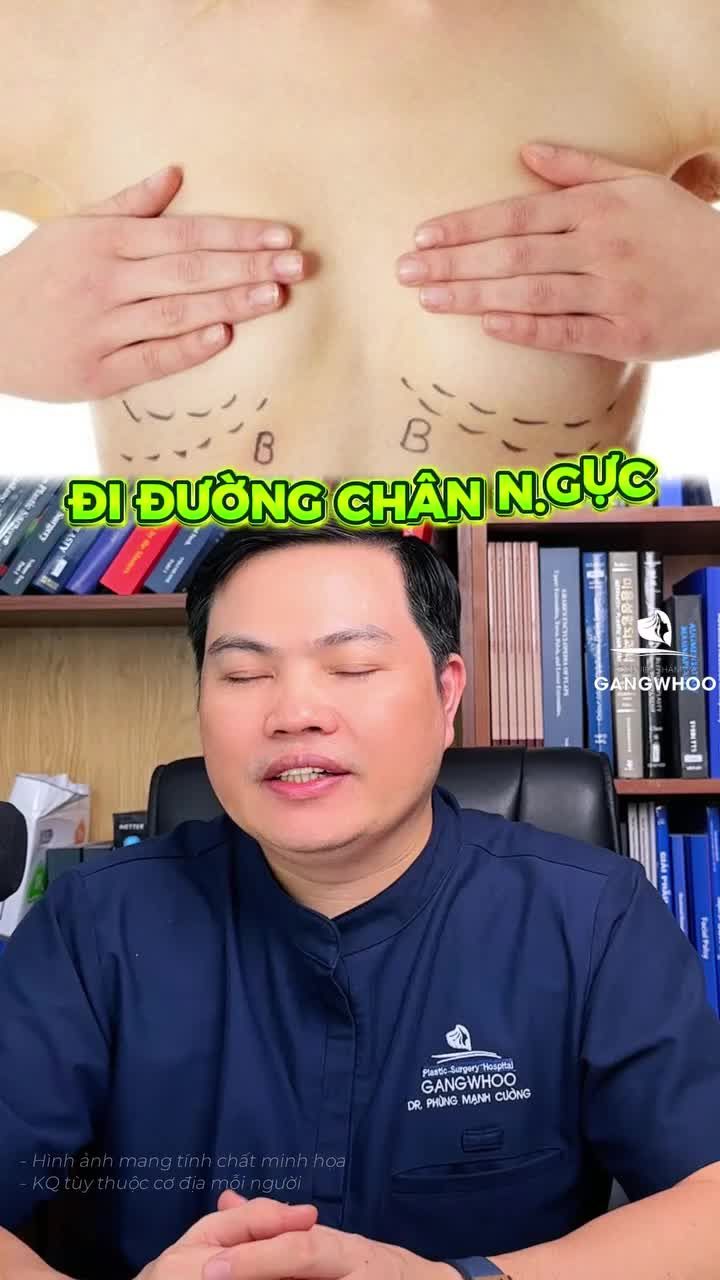 Người Á Đông có nên chọn đường chân ngực khi nâng V1?