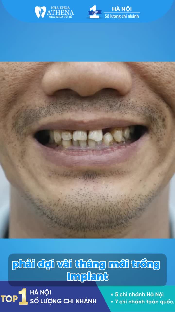 Trồng răng Implant tức thì là gì?