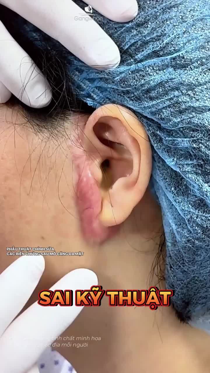 Kết quả sau 1 tháng sửa sẹo do căng da mặt lỗi tại nơi khác  DMKT: Phẫu thuật chỉnh sửa các biến chứng sau mổ căng da mặt