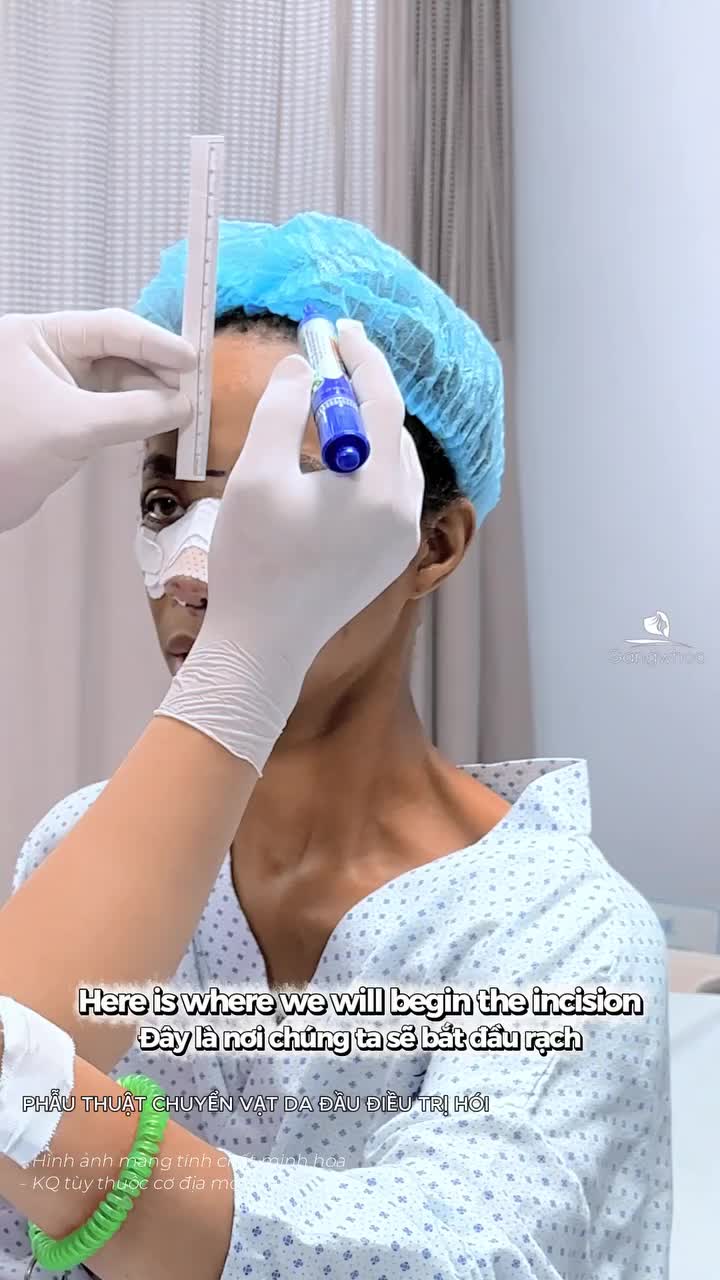 Kết quả hạ đường chân tóc nội soi vi phẫu cho bạn khách Mỹ sau 15 ngày DMKT: PHẪU THUẬT CHUYỂN VẠT DA ĐẦU ĐIỀU TRỊ HÓI
