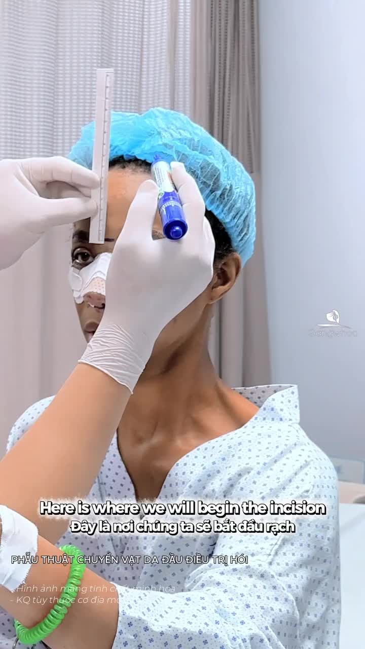 Kết quả hạ đường chân tóc nội soi vi phẫu cho bạn khách Mỹ sau 15 ngày DMKT: PHẪU THUẬT CHUYỂN VẠT DA ĐẦU ĐIỀU TRỊ HÓI