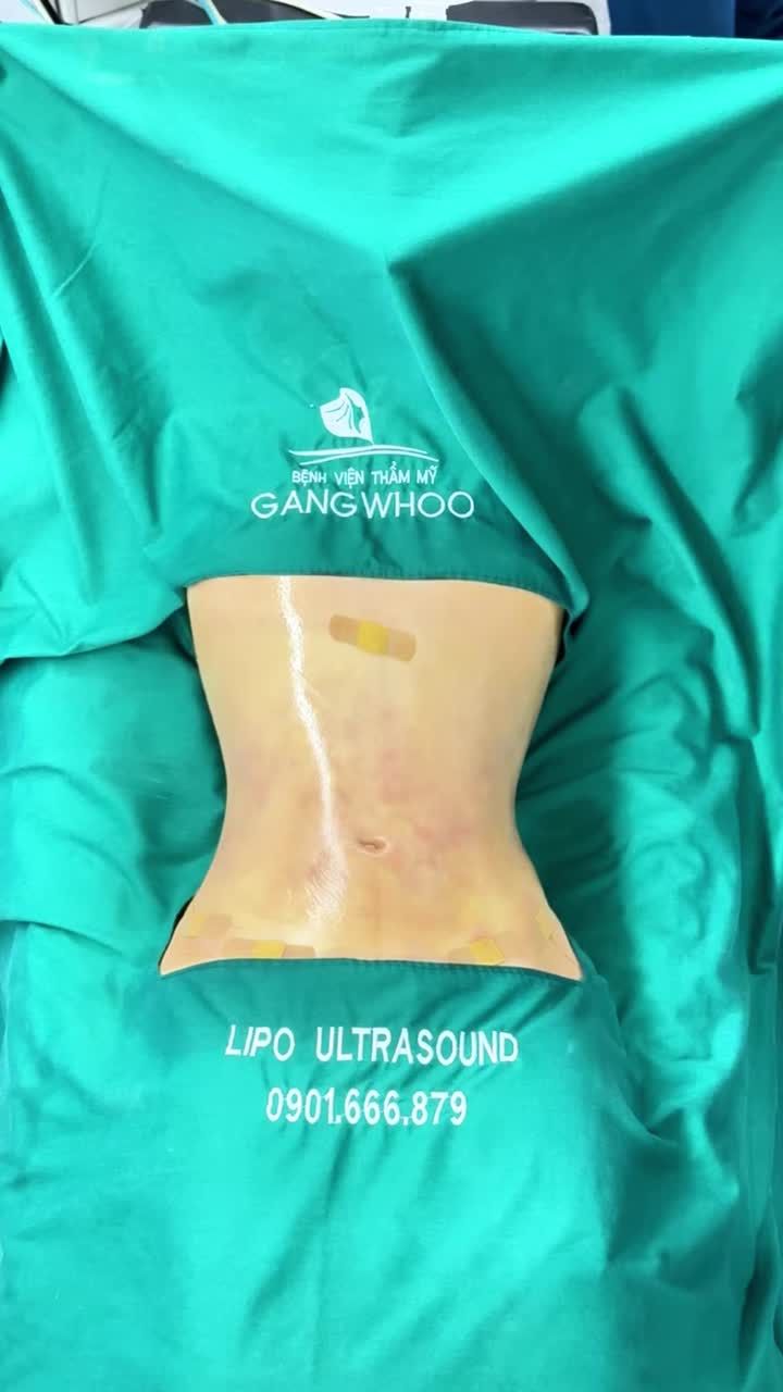 KHÁCH HÀNG VƯỢT QUA NỖI SỢ ĐAU SAU PHẪU THUẬT HÚT MỠ (LIPO)