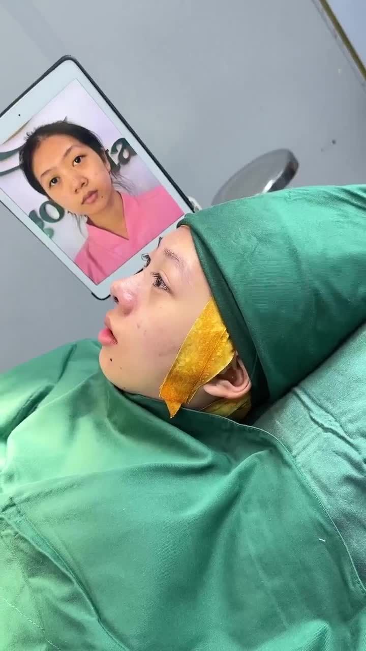 KẾT QUẢ SAU 60 PHÚT NÂNG MŨI SỤN SURGIFORM KH. DIỆU LINH