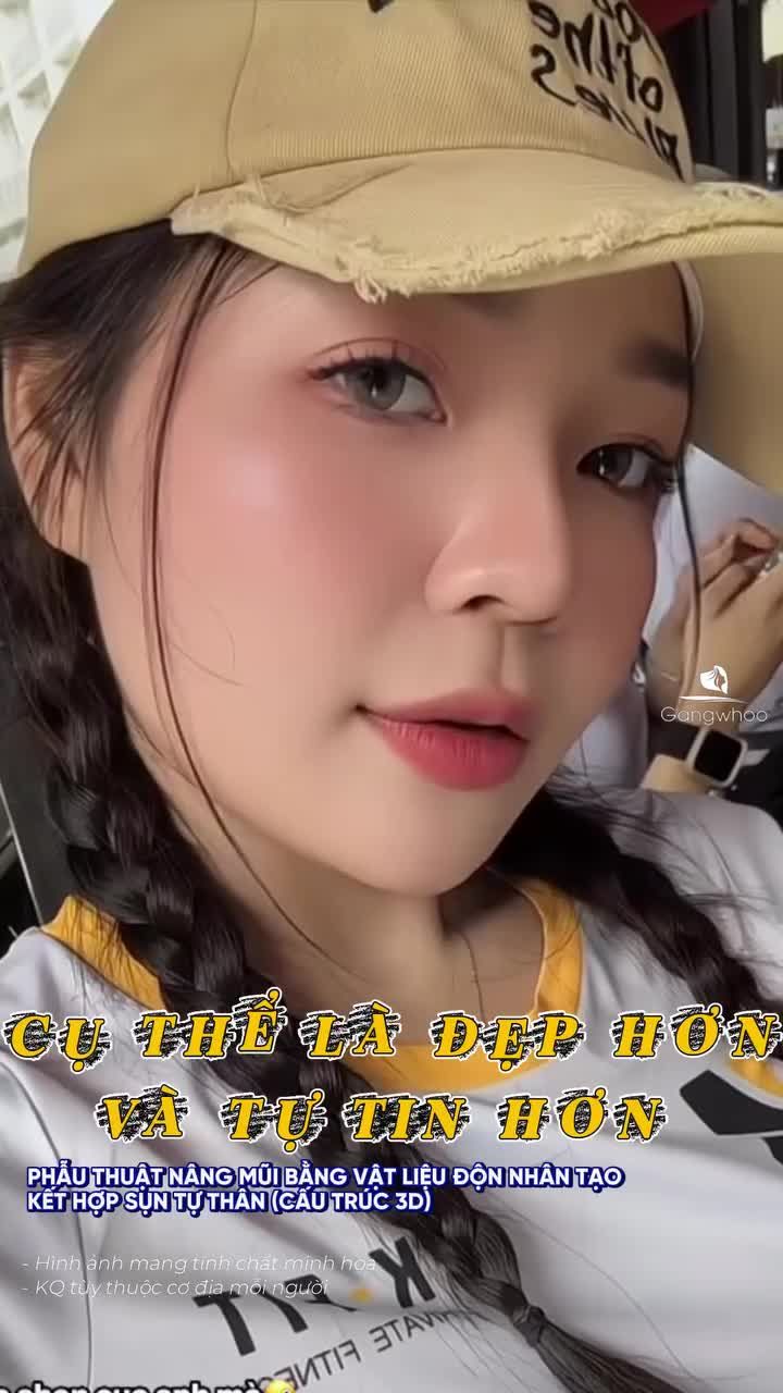 Phẫu thuật nâng mũi bằng vật liệu độn nhân tạo kết hợp sụn tự thân (cấu trúc 3D) đã khiến tôi trở thành con người khác, cụ thể là đẹp hơn, tự tin hơn