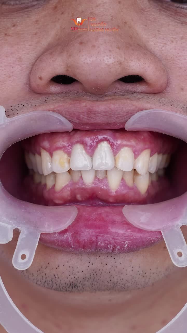 CHỌN VIP DENTIST KIẾN TẠO NỤ CƯỜI PHONG ĐỘ, TỰ TIN