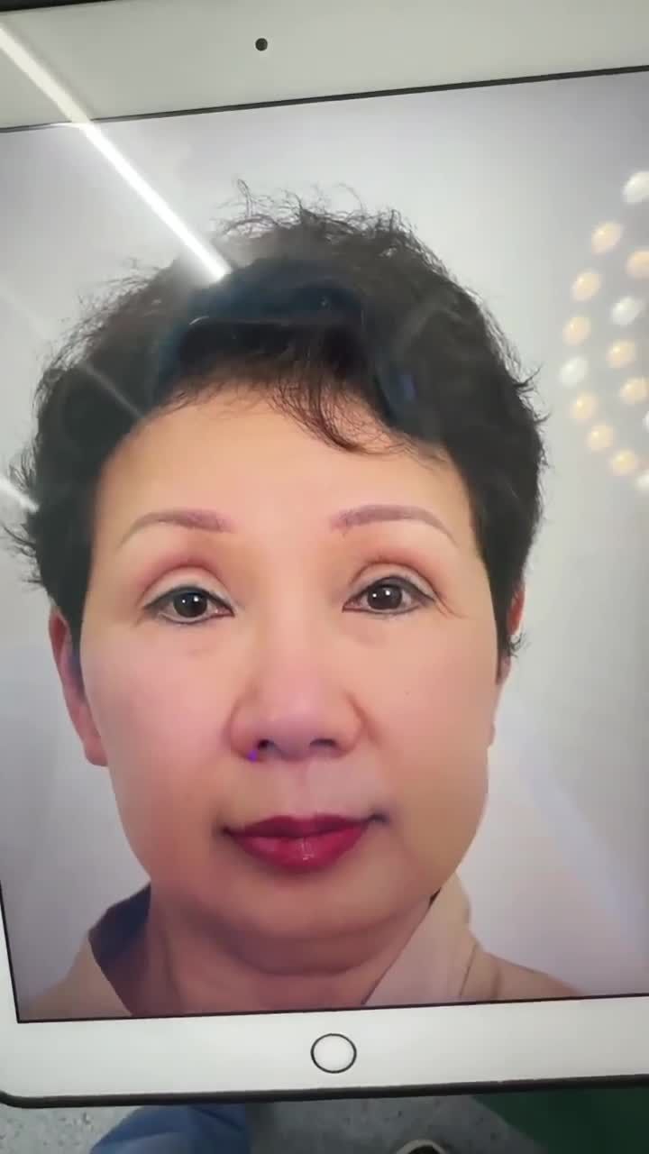 CẮT MÍ SỬA LẠI - HẠ SIZE MÍ KH. TRAN CATSEY LE (VIỆT KIỀU MỸ)