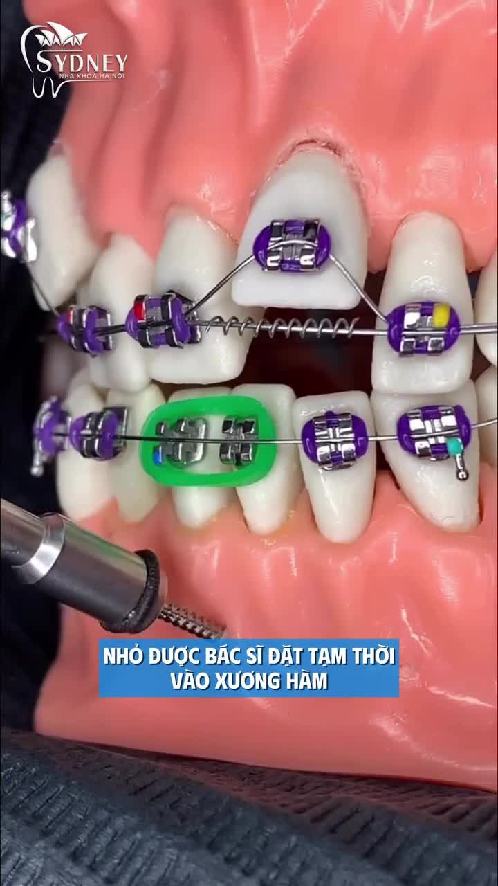 Vai trò của Minivis trong quá trình niềng răng