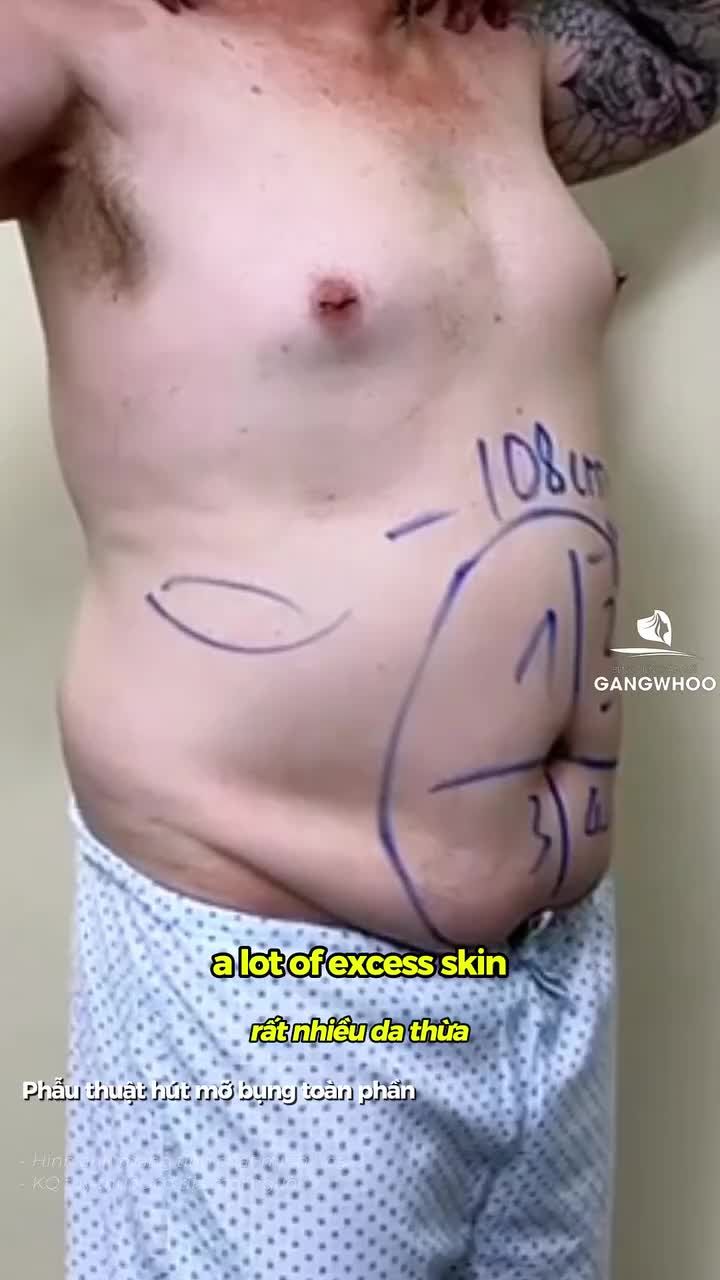 Khách hàng nam Úc - 1 ngày sau hút mỡ toàn phần bụng tại Bệnh viện Thẩm mỹ Gangwhoo