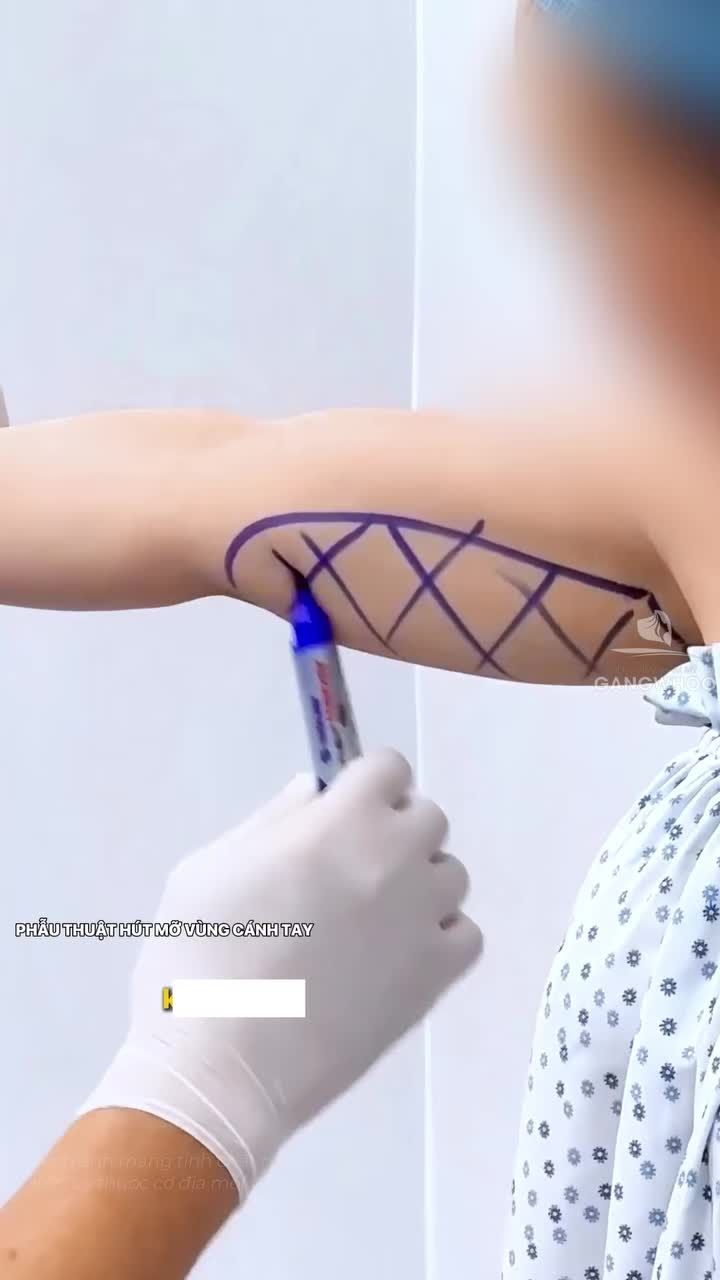 Trước và sau 30 phút phẫu thuật hút mỡ vùng cánh tay tại BVTM Gangwhoo