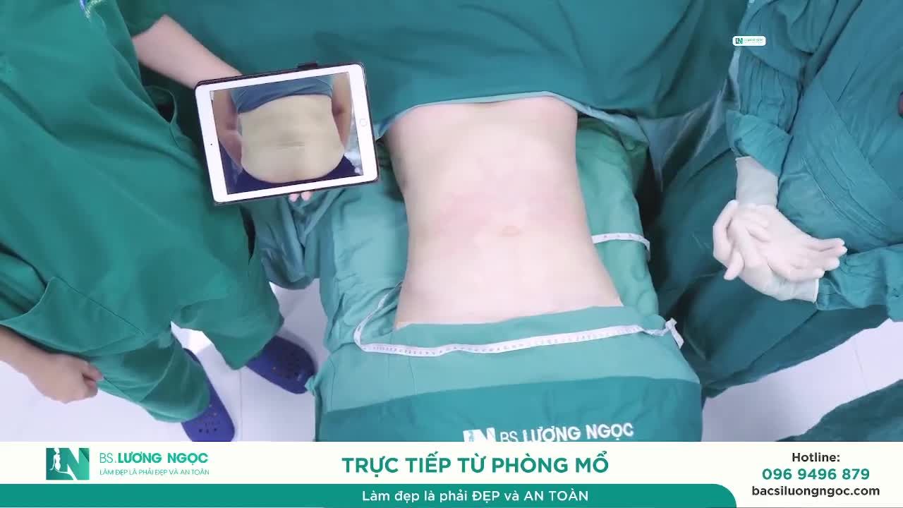 KHÁCH HÀNG SAU NHIỀU LẦN SINH – LỘT XÁC VÒNG EO, HOÀN THIỆN VÒNG 1