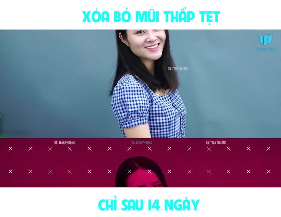 CHẲNG CẦN ĐẾN 10 NĂM ĐỂ "LỘT XÁC" - CHỈ 14 NGÀY NÂNG MŨI CẤU TRÚC BẠN GÁI NÀY ĐÃ THAY ĐỔI NGOẠN MỤC RỒI