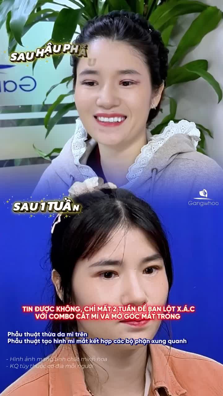 Kết quả sau 2 tuần với combo cắt mí và mở góc mắt trong, khách hàng thay đổi với diện mạo mới xinh đẹp. Quá trình hồi phục nhanh chóng giúp bạn sớm lấy lại tự tin!