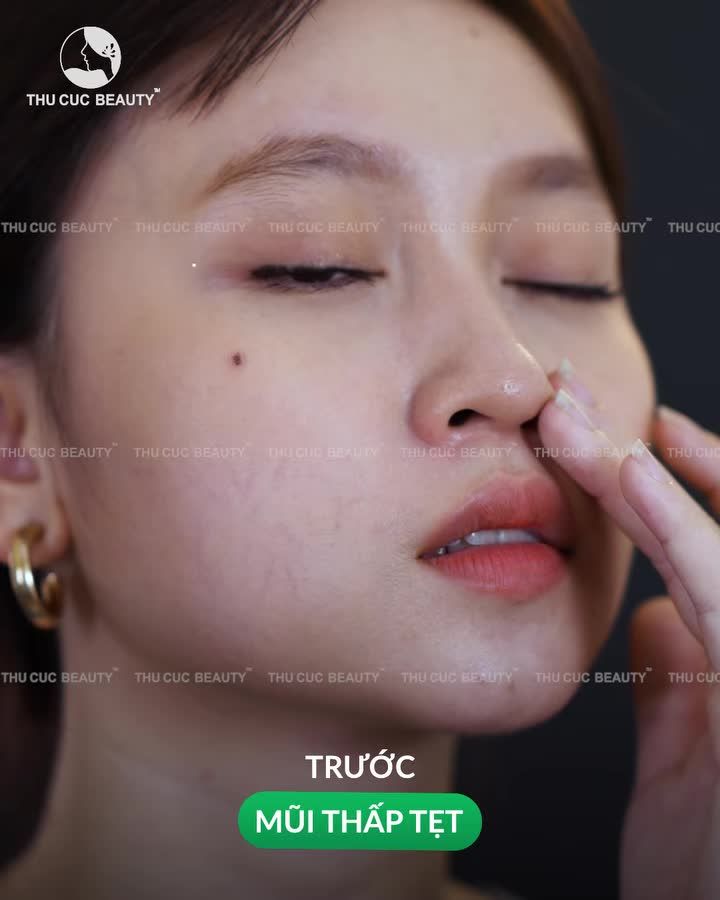 óa sổ mũi tẹt sau 30P tại Thu Cúc Không đau. Không nghỉ dưỡng dài ngày