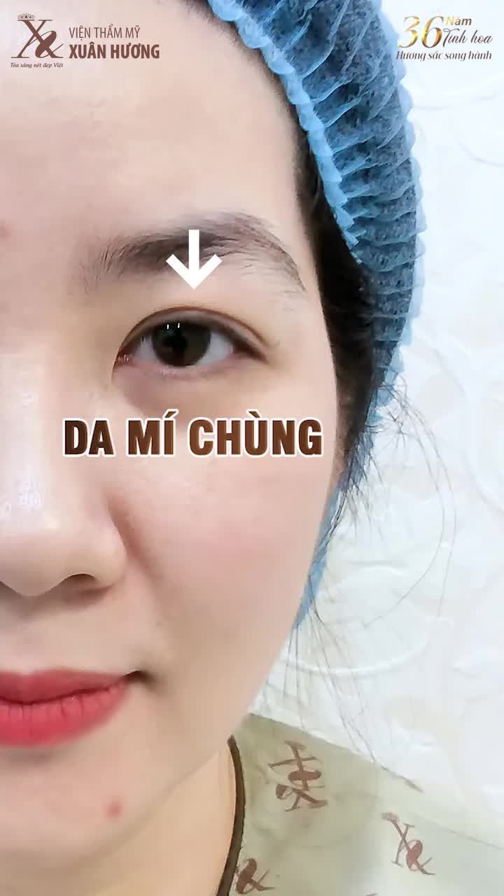 45 PHÚT “LỘT XÁC” SAU KHI LÀM COMBO CẮT MÍ + MỞ GÓC MẮT TẠI VTM XUÂN HƯƠNG