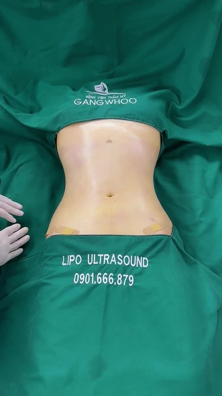KẾT QUẢ HÚT MỠ LIPO ULTRASOUND SAU 60 PHÚT: VÒNG EO "CON KIẾN" LỘ DIỆN TỨC THÌ!