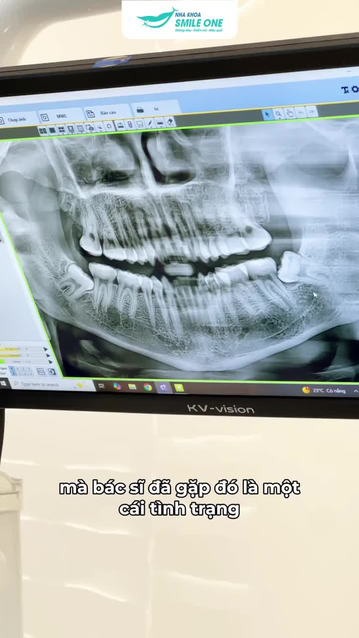 Răng số 8 mọc ngang, đâm sang răng số 7, nếu không xử lý sớm có thể khiến hỏng cả hàm răng!