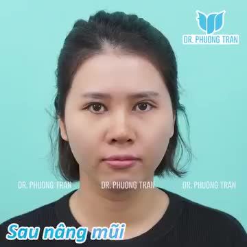 Không có dáng mũi chung cho tất cả, chỉ có dáng mũi phù hợp với từng gương mặt.