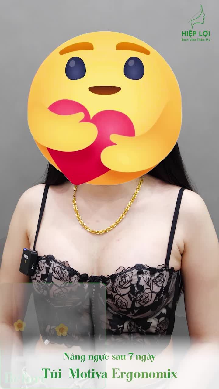 Khách hàng chia sẻ cảm nhận sau khi nâng ngực tại BVTM Hiệp Lợi