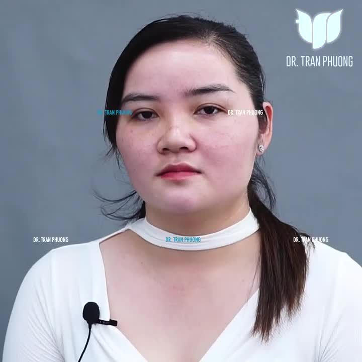 NÂNG MŨI HOÀN TOÀN KHÔNG CÓ CẢM GIÁC ĐAU: CẢM NHẬN CỦA BÉ TƯ SAU 14 NGÀY PHẪU THUẬT