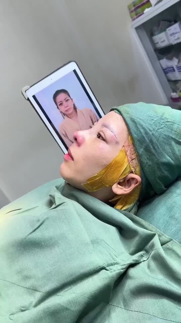 KẾT QUẢ NÂNG MŨI CẤU TRÚC + TREO CUNG CHÂN MÀY KH. DIỄM MY (SÓC TRĂNG)