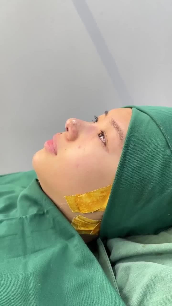 KẾT QUẢ NÂNG MŨI CẤU TRÚC KH. KIỀU CHINH (VIỆT KIỀU MỸ)