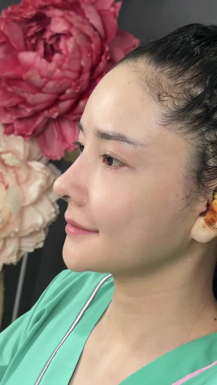 Mũi lệch, bao xơ, sẹo nhiều khắc phục hoàn toàn ngay sau 90 phút - Đẹp thanh tú, cực kỳ sắc nét.