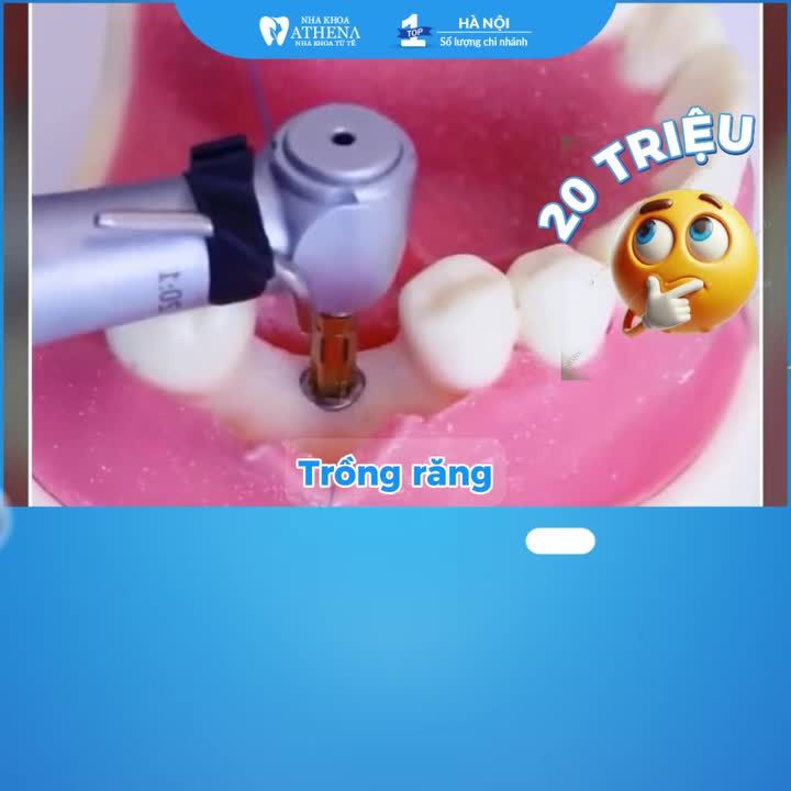 ĐỪNG TRỒNG IMPLANT KHI BẠN CHƯA BIẾT SỰ THẬT NÀY!