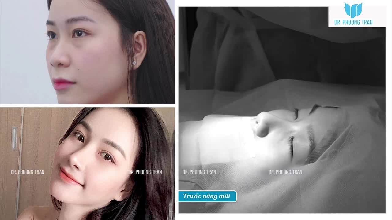 NÂNG MŨI MÀ “GẦN NHƯ KHÔNG CÓ CẢM GIÁC ĐAU” – BẠN CÓ TIN KHÔNG?