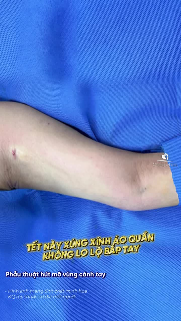 Tết này xúng xính áo quần không lo lộ bắp tay nha chị em