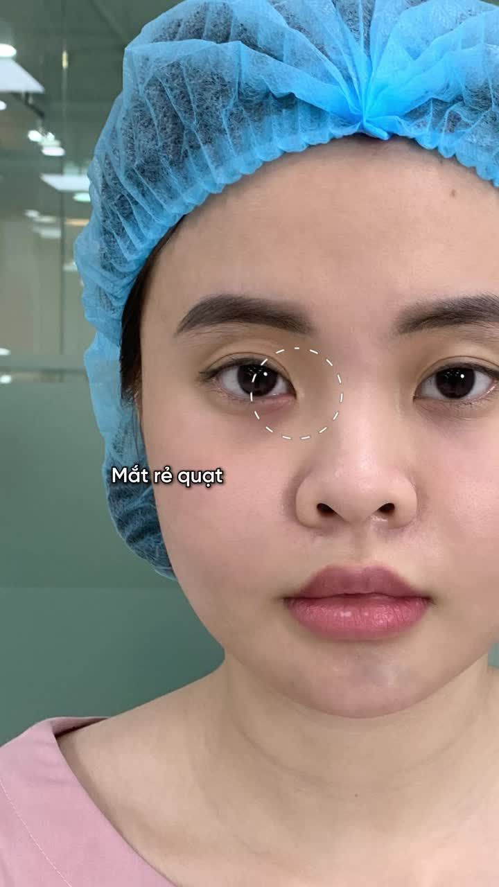 “Đôi mắt từng khiến mình trông mệt mỏi và già hơn tuổi. Sau khi cắt mí tại Tấm, mắt gọn gàng, tươi tắn hơn hẳn. Thật sự may mắn vì đã chọn đúng nơi.”