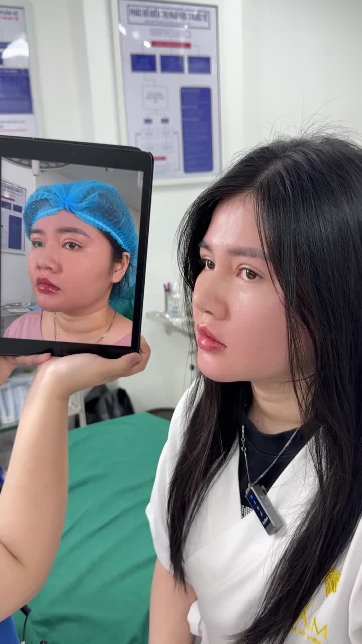 Thời gian đầu nâng mũi chỉ, Hiền khá ưng ý. Vài tuần sau, mũi bắt đầu lệch rõ sang một bên.