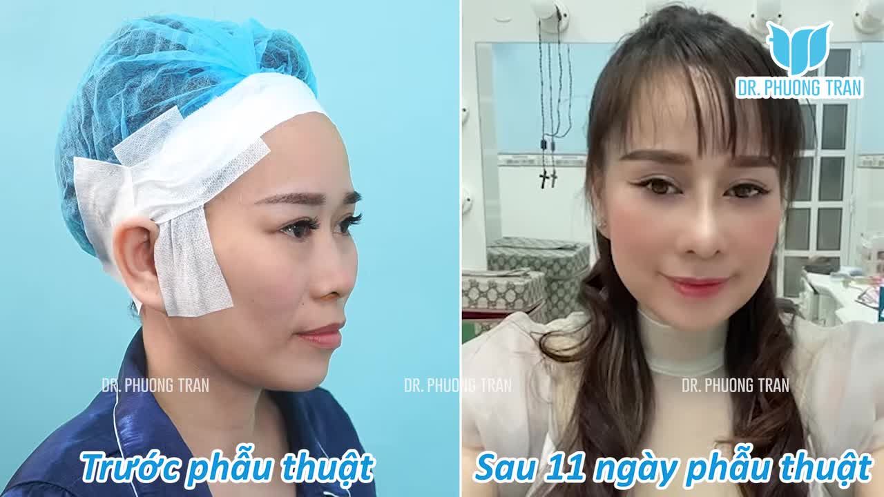 TỰ TIN KHOE NHAN SẮC CHỈ SAU 11 NGÀY THỰC HIỆN COMBO NÂNG MŨI + CẤY MỠ + XÓA RÃNH MŨI MÁ