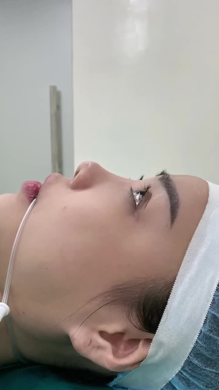 Hài hòa, tự nhiên, đẹp chuẩn tỉ lệ vàng chỉ sau 90 phút nâng mũi cấu trúc!!