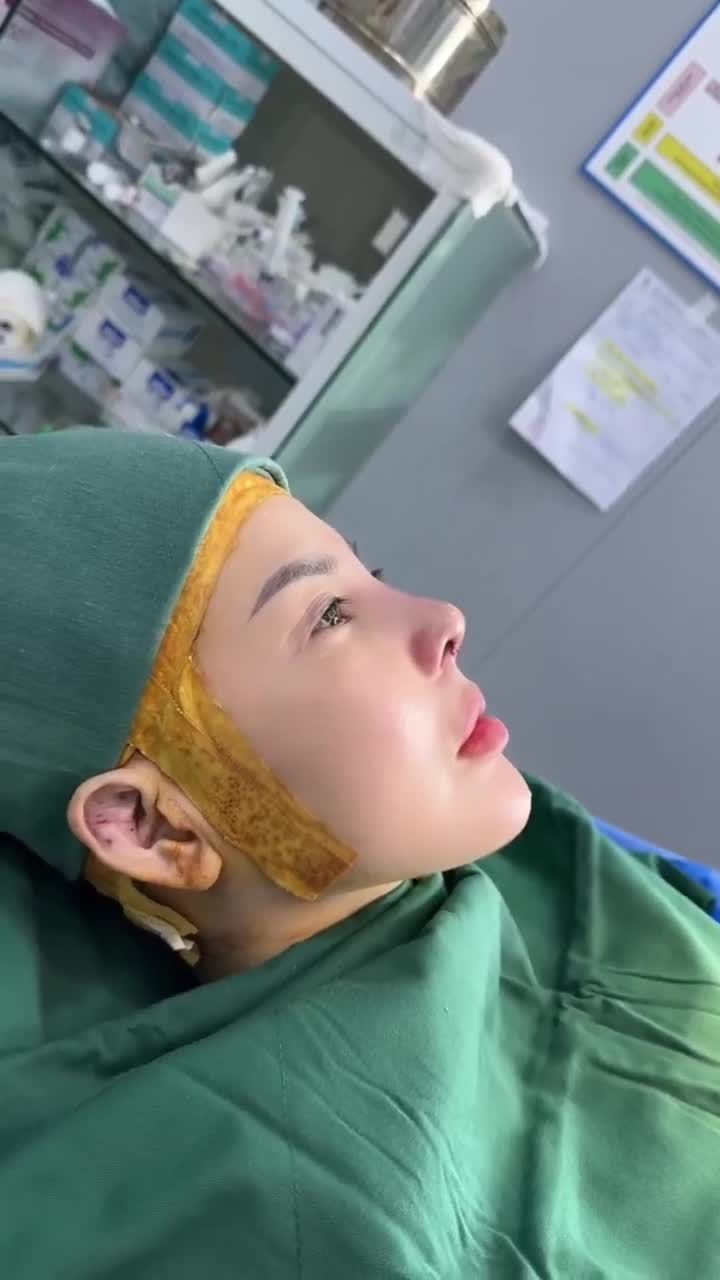 KẾT QUẢ "TÁI SINH" CHIẾC MŨI SAU 5 LẦN SỬA MŨI HỎNG