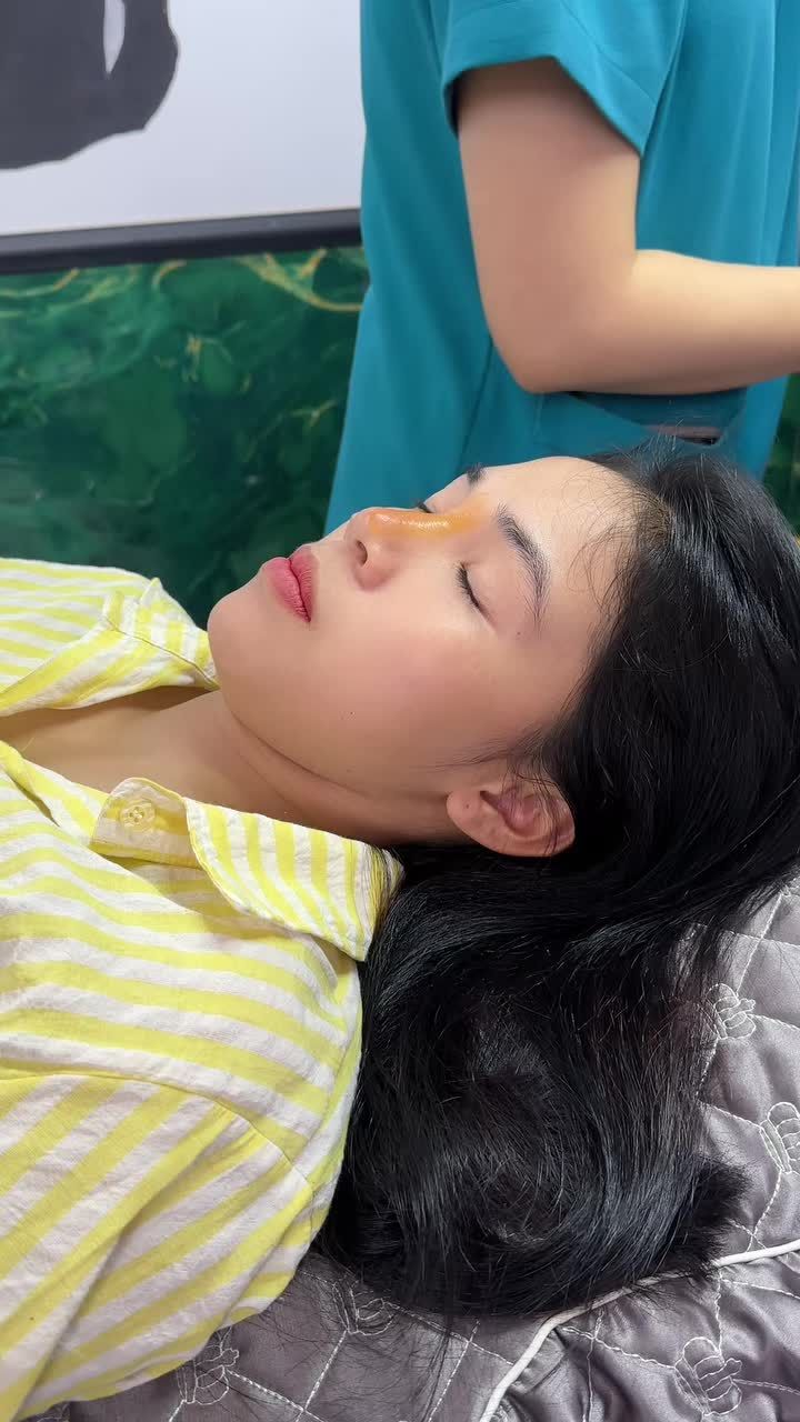 Mũi tháo nẹp sau 10 ngày - Đẹp chấn động!!