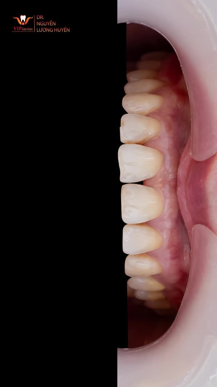 TỪ HÀM RĂNG Ố VÀNG ĐẾN NỤ CƯỜI TỰ TIN NHẤT !