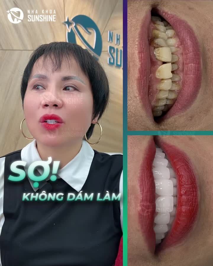 TRƯỚC KHI LÀM RĂNG SỨ NHƯNG SỢ BUỐT - SỢ ĐAU KHÔNG DÁM LÀM, NHƯNG SAU KHI TRỰC TIẾP TRẢI NGHIỆM, KẾT QUẢ LÀ