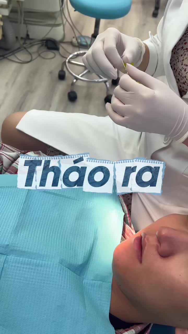 Vài hôm trước nha khoa đã chia sẻ cho mọi người thấy hành trình niềng răng thành công rực rỡ của Quốc Vinh