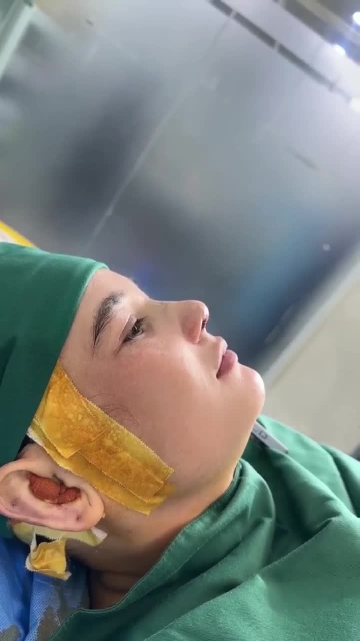 KẾT QUẢ NÂNG MŨI CẤU TRÚC CHO KHÁCH HÀNG TỪNG CÓ BỆNH LÝ VỀ MŨI