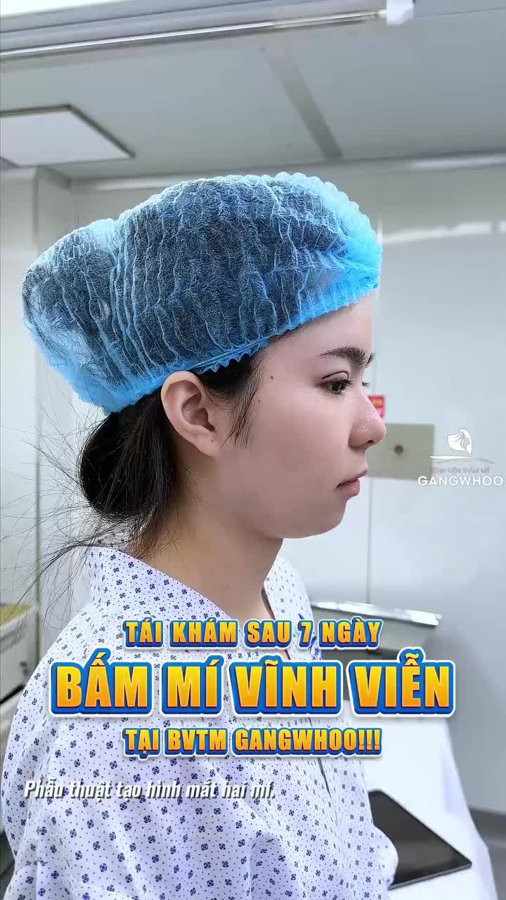 Tái khám sau 7 ngày bấm mí vĩnh viễn tại BVTM Gangwhoo. Mí đã vào nếp ổn định, sưng giảm nhiều và đường mí rõ nét hơn từng ngày, nhìn một cái là thấy dễ thương hơn hẳn.