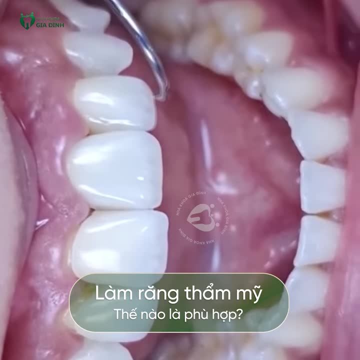 LÀM RĂNG SỨ NHƯ THẾ NÀO LÀ PHÙ HỢP?
