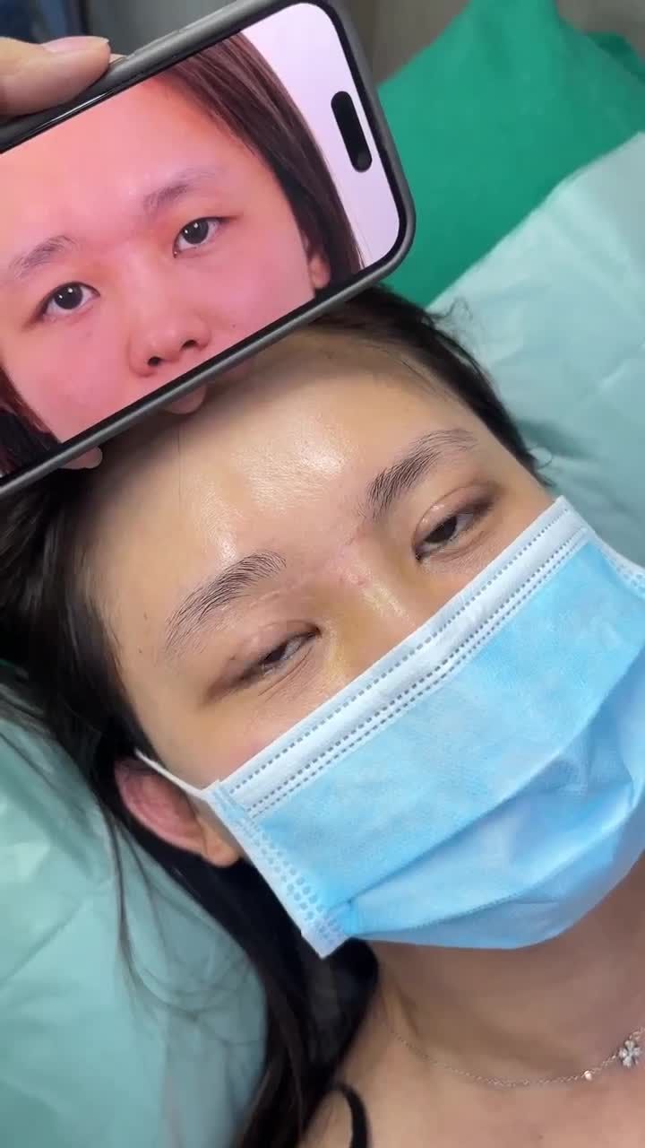 MÍ ĐẸP TỰ NHIÊN CHỈ SAU 10 NGÀY CẮT MÍ MINI DEEP