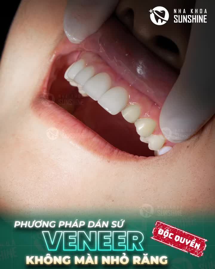 CẬN CẢNH DÁN SỨ VENEER KHÔNG MÀI NHỎ RĂNG TẠI SUNSHINE