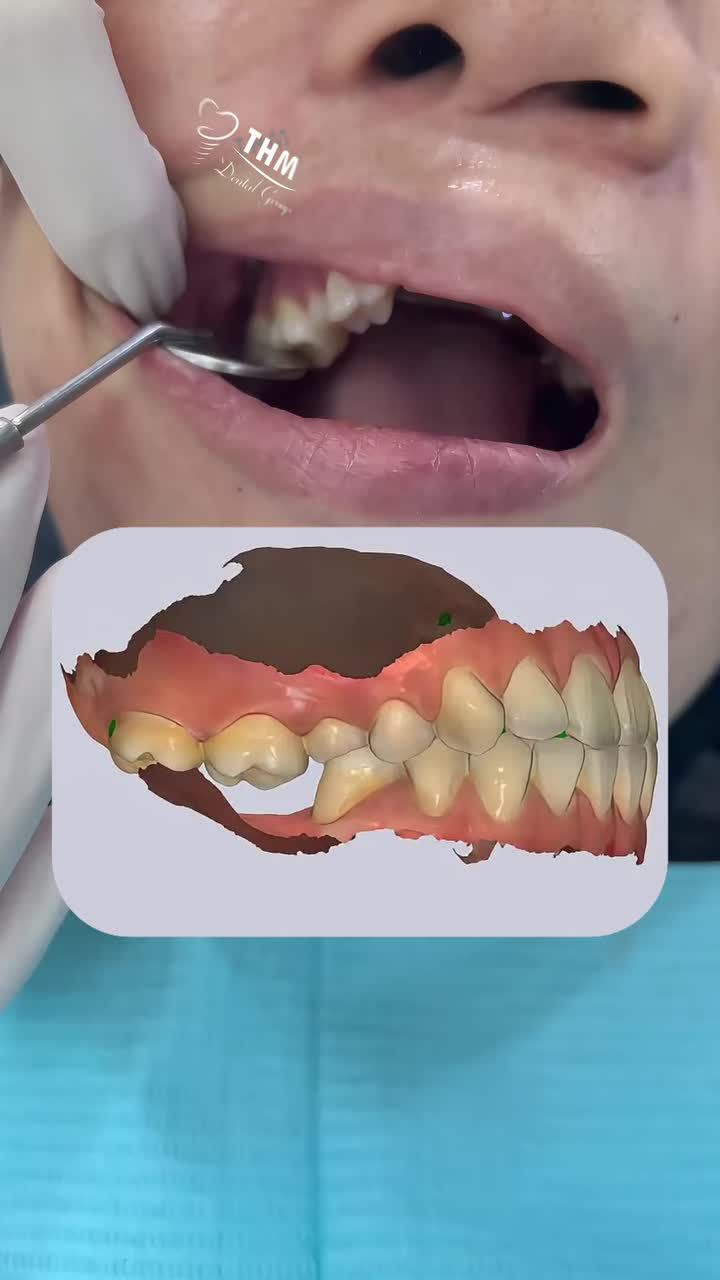 Thay đổi diện mạo ngoạn mục , thay chuỗi và đánh lún răng